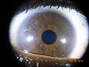 Iridologia - Foto de íris obtida com o Iridophoto HX