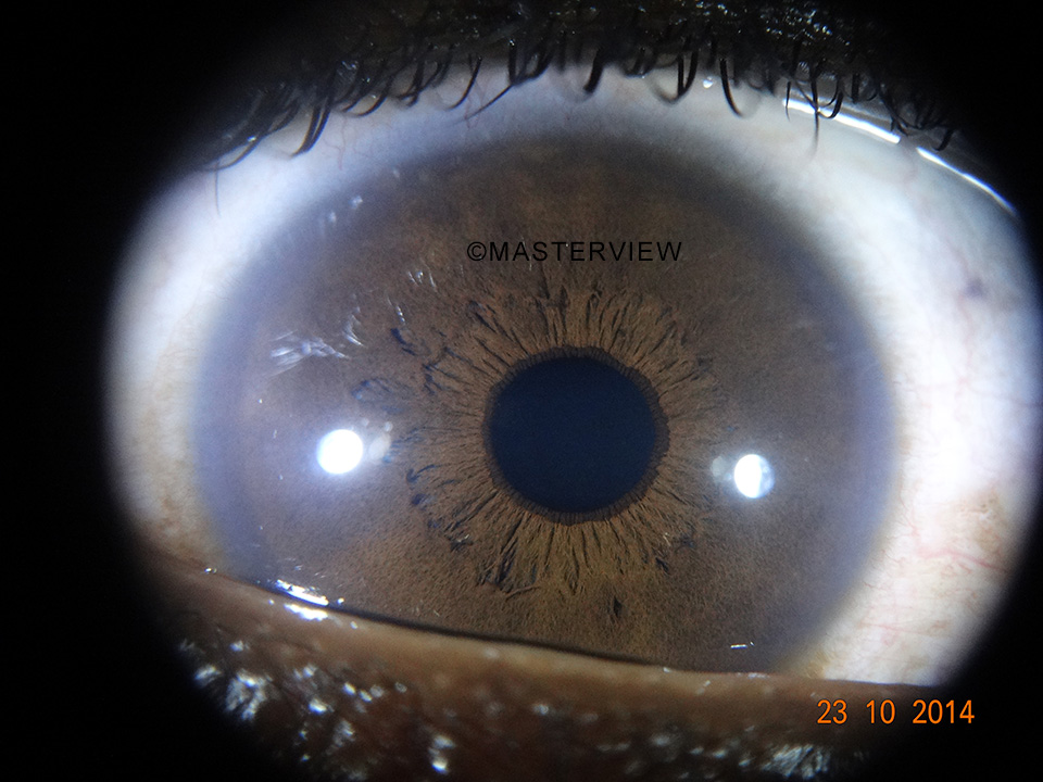 Iridologia - Foto de íris obtida com o Iridophoto HX