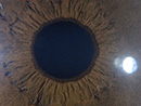 Iridologia - Foto de íris obtida com o Iridophoto HX